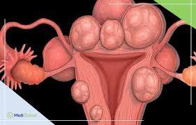 Gynae Cancer Awareness